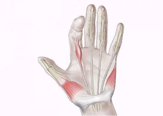 La inflamación del tendón causa dolor en las articulaciones de los dedos