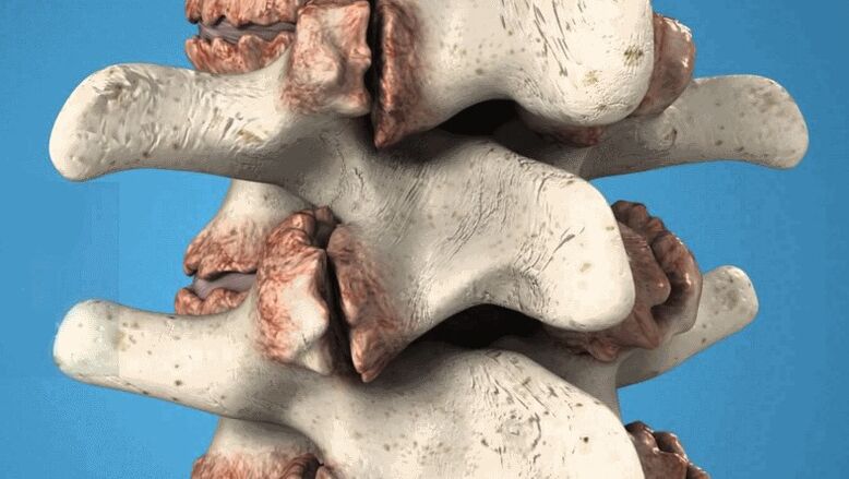 Los osteofitos espinales son la causa del dolor lumbar