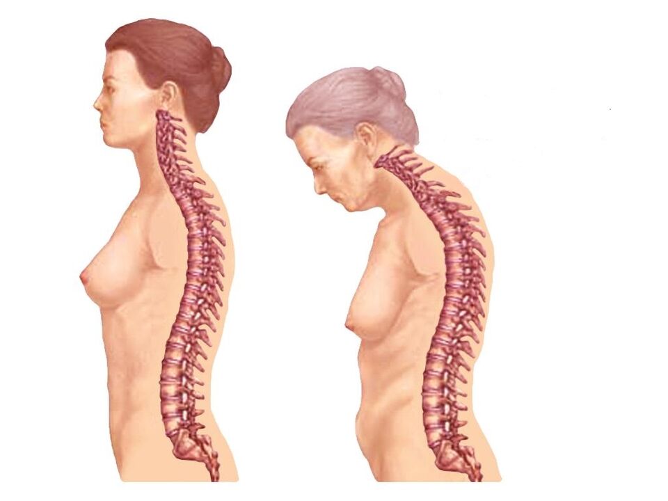 Columna vertebral curva sana con osteocondrosis