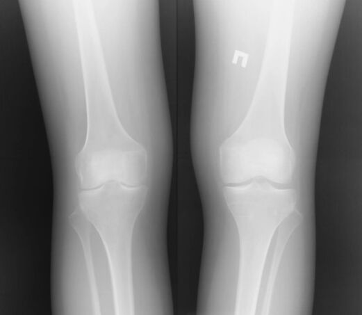 Rayos X de la rodilla