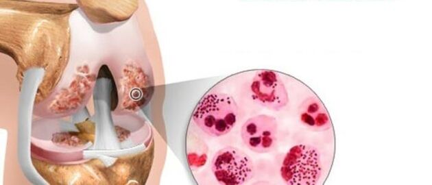 Causa el desarrollo articular
