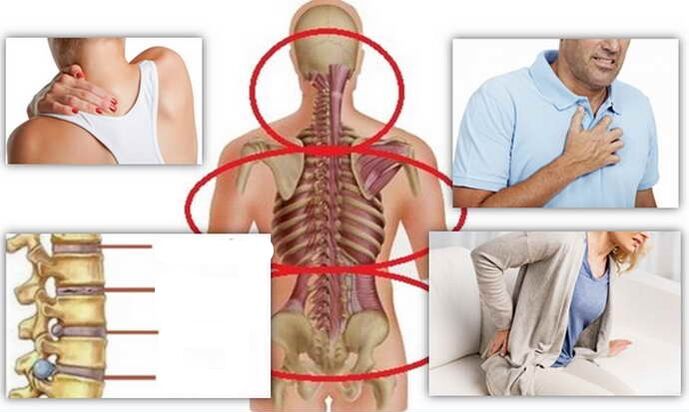 Enfermedades de la osteocondrosis