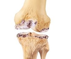 Lesiones de rodilla causadas por las articulaciones.
