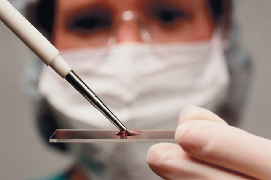 La artritis es una enfermedad inflamatoria que se puede detectar con un análisis de sangre.