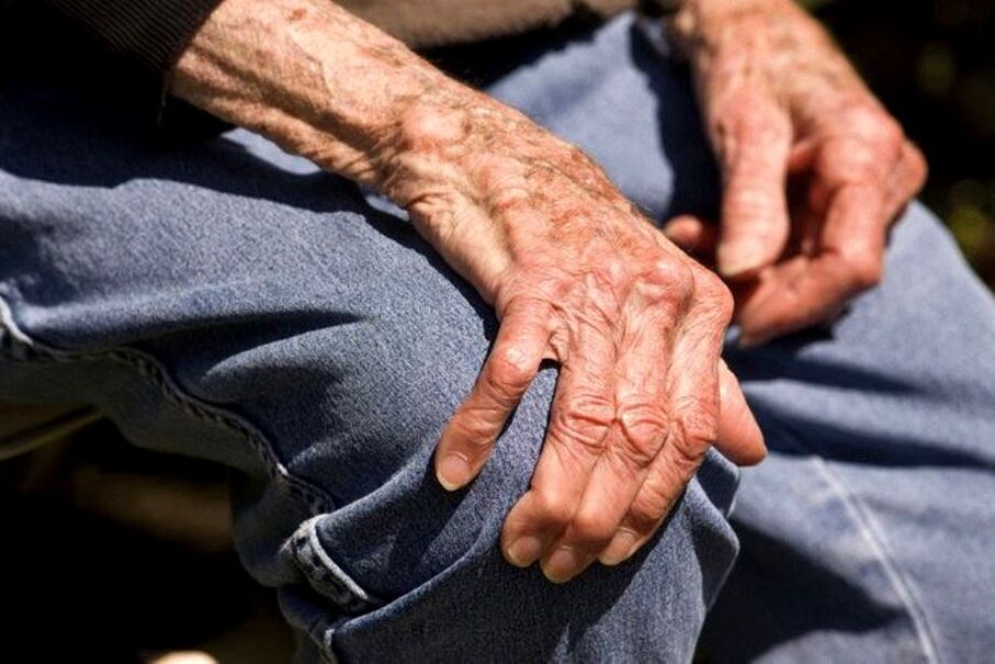 La artropatía es una enfermedad relacionada con la edad que se presenta en adultos mayores.