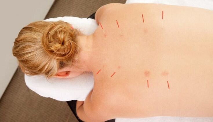 La acupuntura trata la osteocondrosis torácica con muchas ventajas