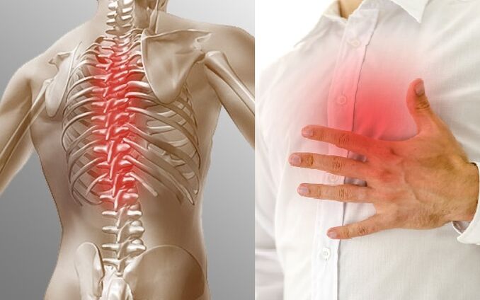 La osteocondrosis torácica se presenta con dolor y opresión en el pecho.
